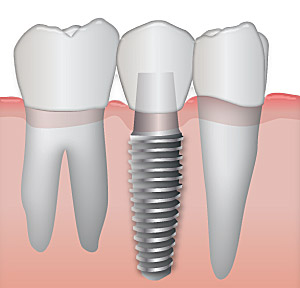 image of Implants:  Replace a missing tooth.