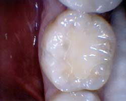 image of Bonded Fillings