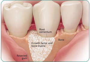 image of Bone Grafting