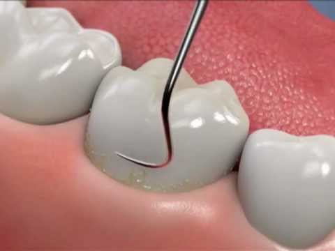 image of Deep Cleanings - Essential to improving gum and bone health.