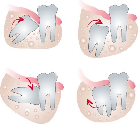 image of Tooth Extractions - Wisdom Teeth, 3rd Molar, etc. 