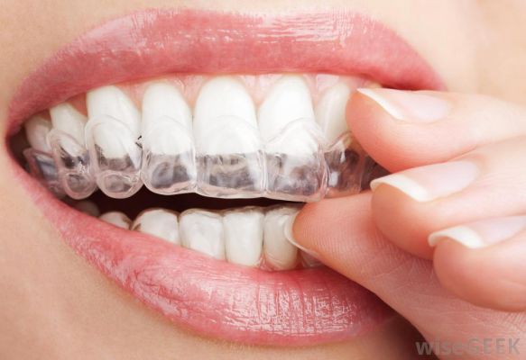 image of Teeth Whitening - In-Home, Comfortable, Custom 